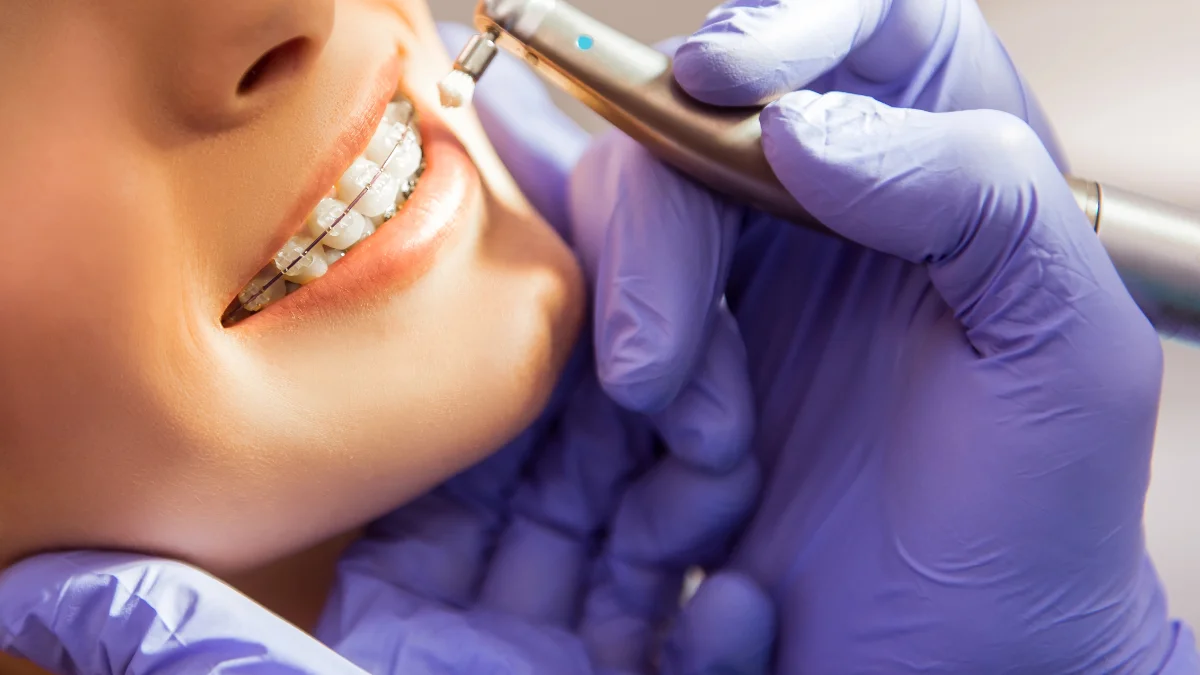 Aparat dentar: tipuri și diferențe explicate