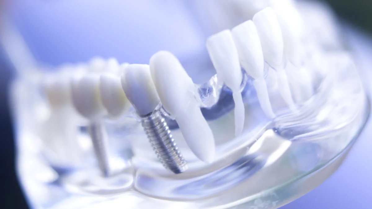 Particulele de titan ar putea explica de ce antibioticele eșuează împotriva infecțiilor cu implanturi dentare