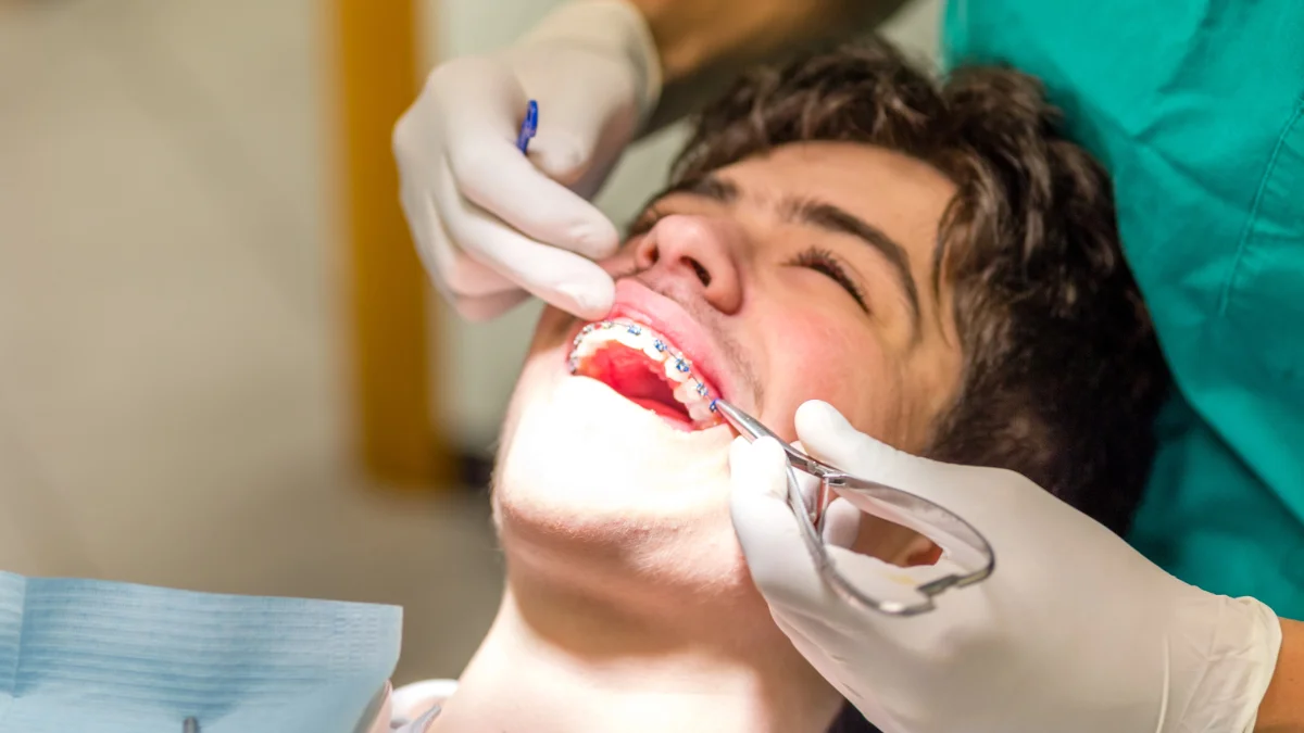 Aparat dentar: tipuri și diferențe explicate