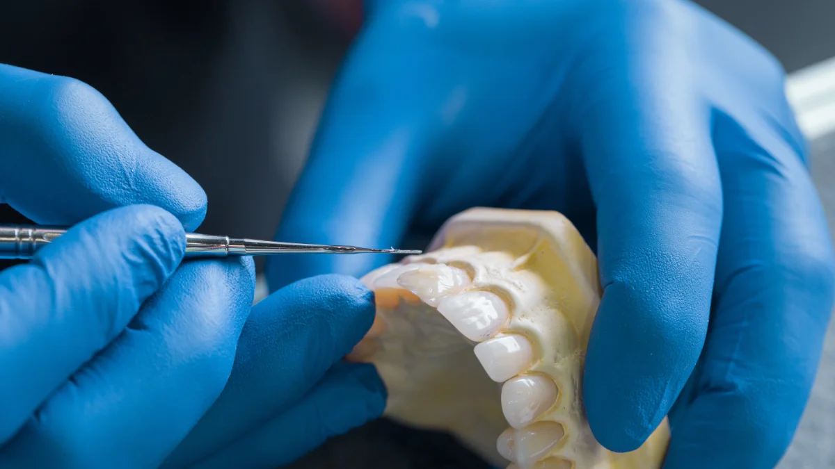 Implant dentar vs punte dentară: ce alegi?